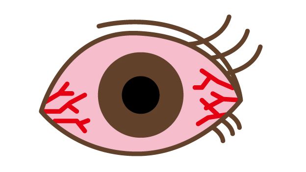 目の充血 イラスト